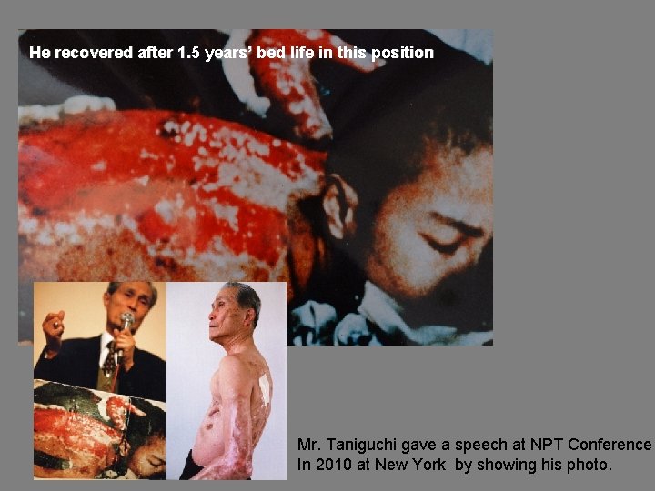 He recovered after 1. 5 years’ bed life in this position Mr. Taniguchi gave