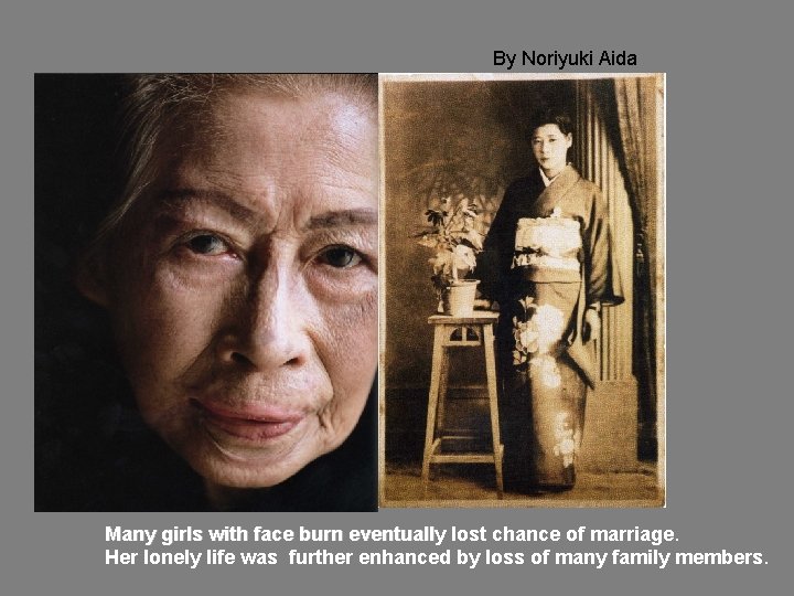 By Noriyuki Aida Many girls with face burn eventually lost chance of marriage Her
