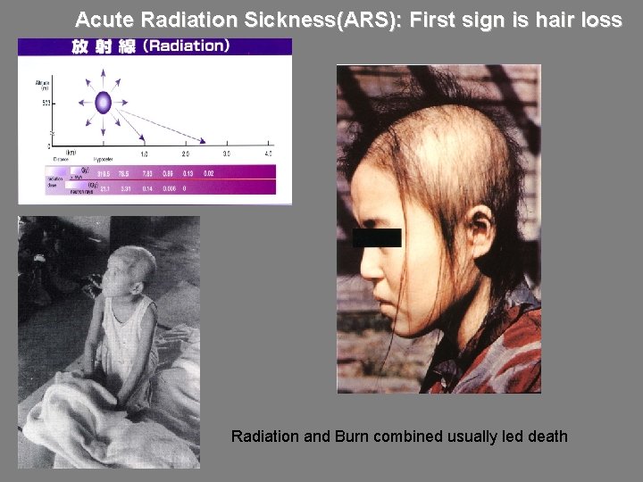 Acute Radiation Sickness(ARS): First sign is hair loss Radiation and Burn combined usually led