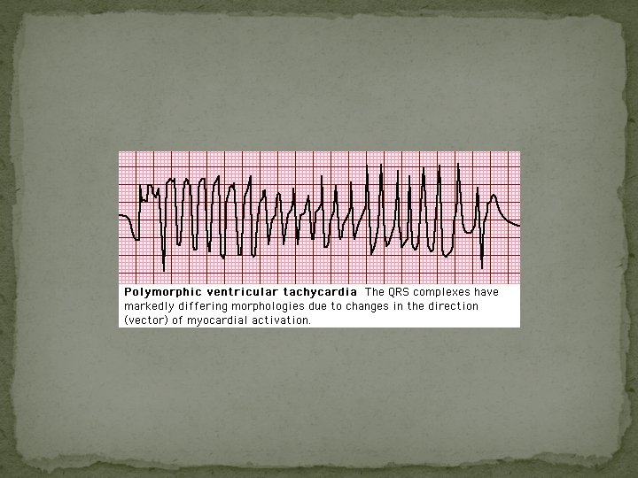 Venricular Arrythmias And Acute Coronary Syndrome Dr Ziad