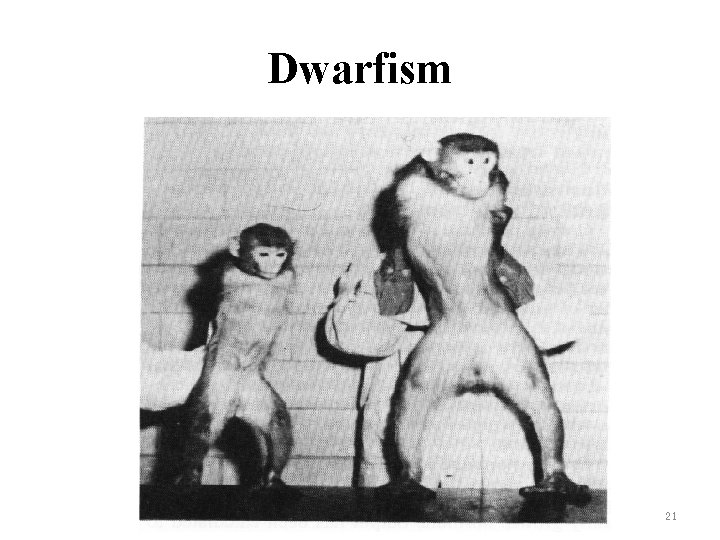Dwarfism 21 Dwarfism 21