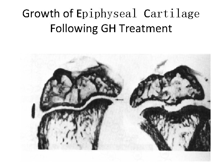 Growth of Epiphyseal Cartilage Following GH Treatment 22 Growth of Epiphyseal Cartilage Following GH Treatment 22
