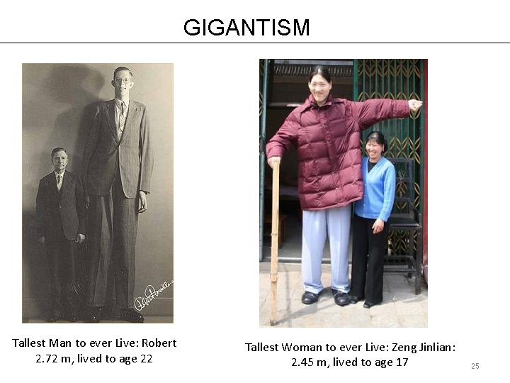 GIGANTISM Tallest Man to ever Live: Robert 2. 72 m, lived to age 22 GIGANTISM Tallest Man to ever Live: Robert 2. 72 m, lived to age 22