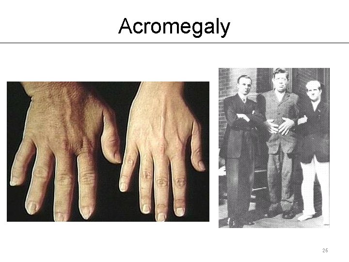 Acromegaly 26 Acromegaly 26