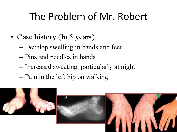 The Problem of Mr. Robert • Case history (In 5 years) – Develop swelling The Problem of Mr. Robert • Case history (In 5 years) – Develop swelling