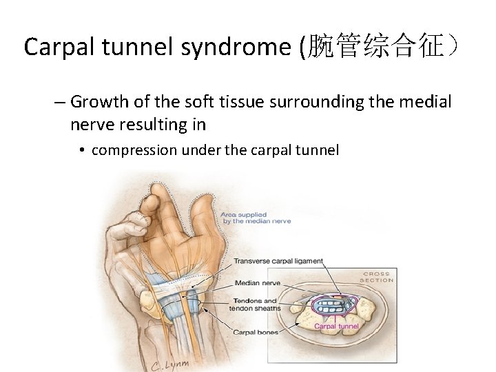 Carpal tunnel syndrome (腕管综合征) – Growth of the soft tissue surrounding the medial nerve Carpal tunnel syndrome (腕管综合征) – Growth of the soft tissue surrounding the medial nerve