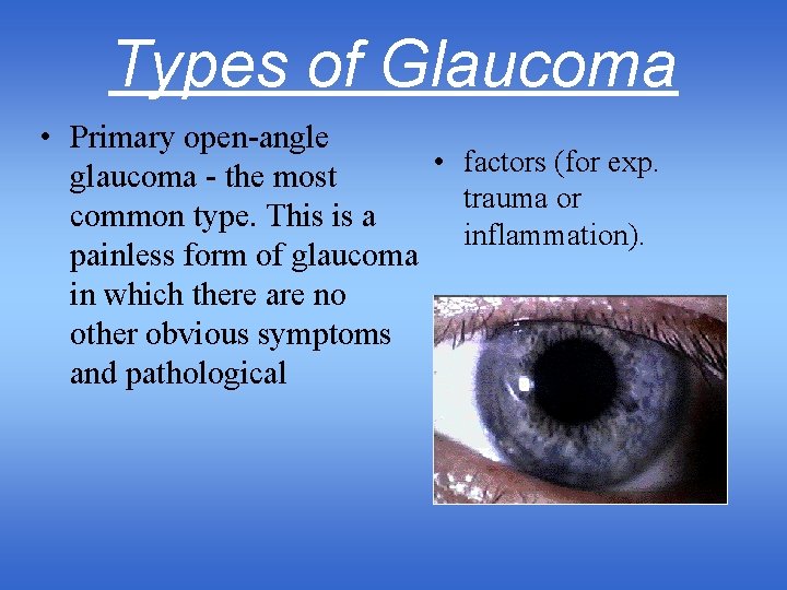 Types of Glaucoma • Primary open-angle • factors (for exp. glaucoma - the most