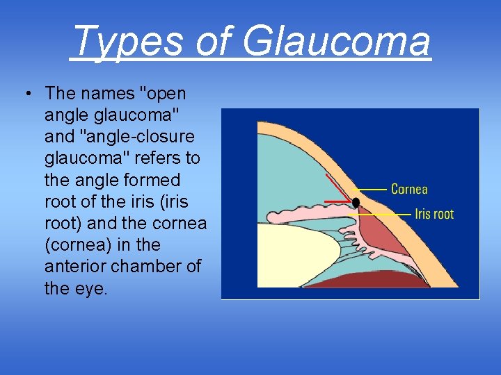 Types of Glaucoma • The names "open angle glaucoma" and "angle-closure glaucoma" refers to