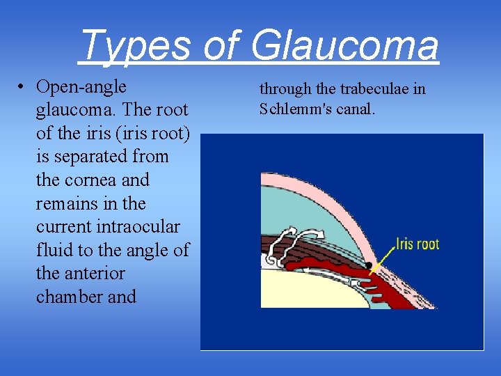 Types of Glaucoma • Open-angle glaucoma. The root of the iris (iris root) is