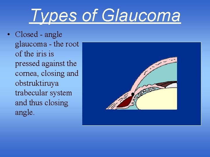 Types of Glaucoma • Closed - angle glaucoma - the root of the iris