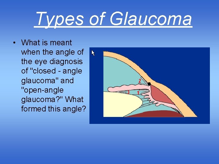 Types of Glaucoma • What is meant when the angle of the eye diagnosis
