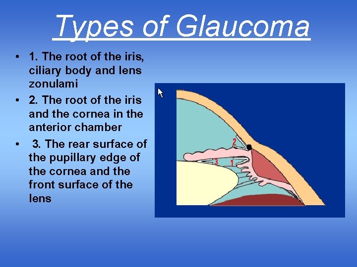 Types of Glaucoma • 1. The root of the iris, ciliary body and lens