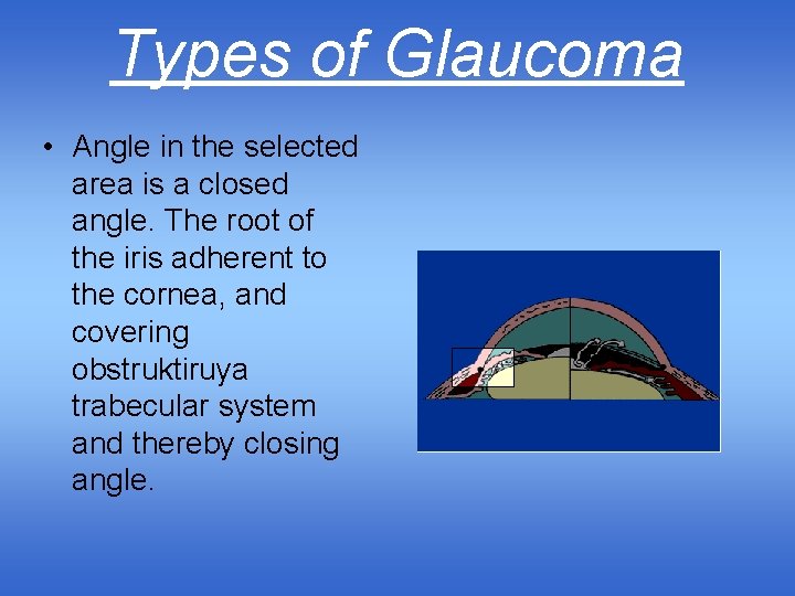 Types of Glaucoma • Angle in the selected area is a closed angle. The