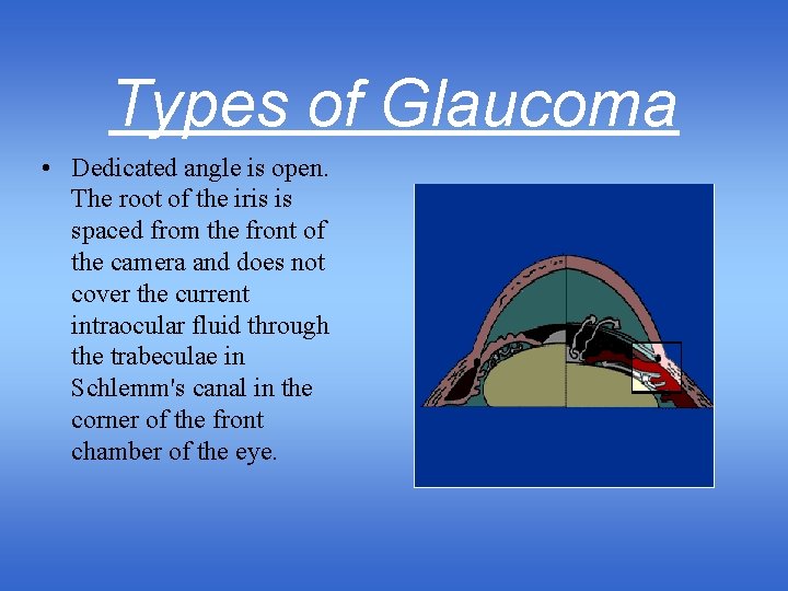 Types of Glaucoma • Dedicated angle is open. The root of the iris is