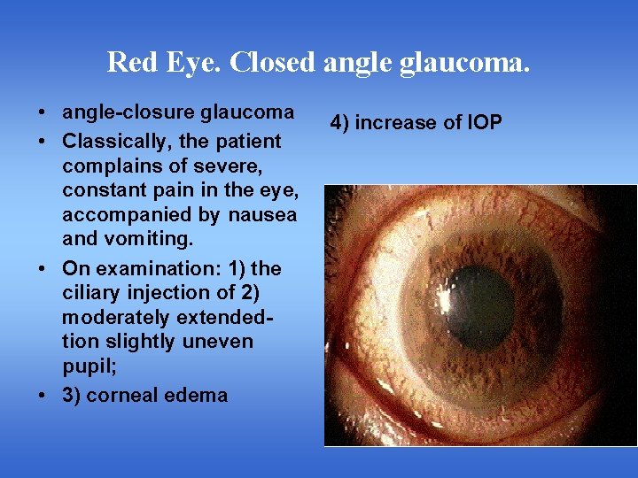 Red Eye. Closed angle glaucoma. • angle-closure glaucoma • Classically, the patient complains of