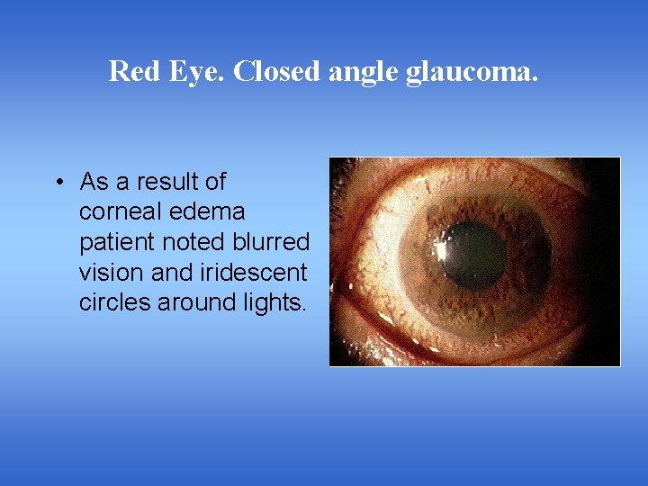 Red Eye. Closed angle glaucoma. • As a result of corneal edema patient noted