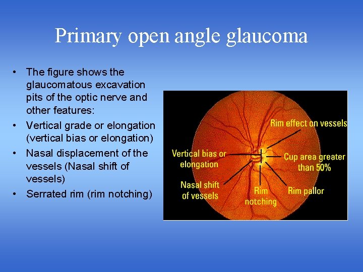 Primary open angle glaucoma • The figure shows the glaucomatous excavation pits of the