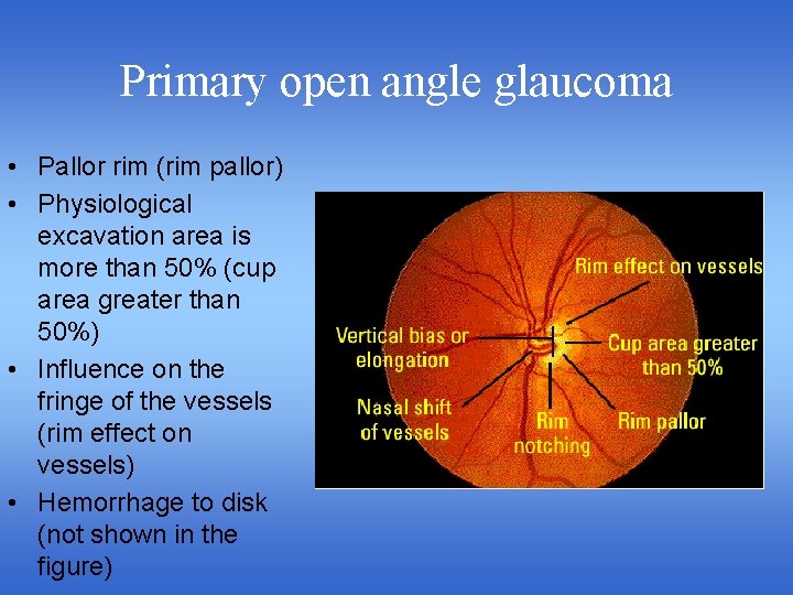 Primary open angle glaucoma • Pallor rim (rim pallor) • Physiological excavation area is