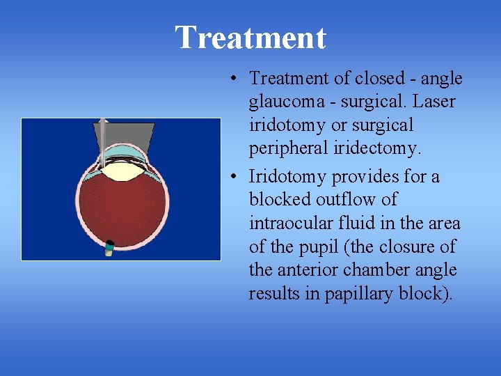 Treatment • Treatment of closed - angle glaucoma - surgical. Laser iridotomy or surgical