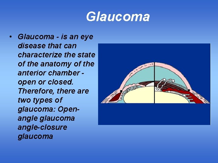 Glaucoma • Glaucoma - is an eye disease that can characterize the state of
