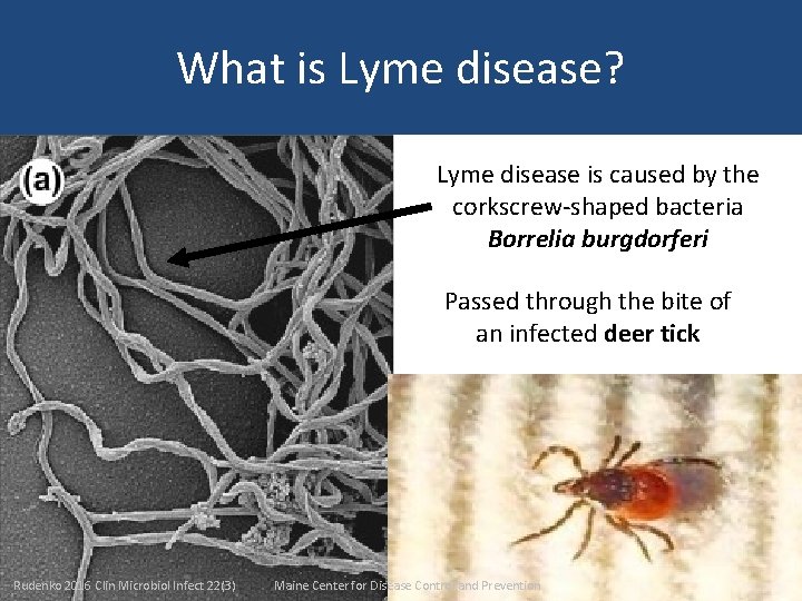 What is Lyme disease? Lyme disease is caused by the corkscrew-shaped bacteria Borrelia burgdorferi