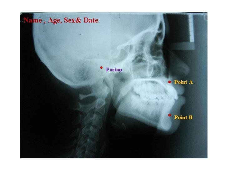 Name , Age, Sex& Date . Porion Point A Point B 