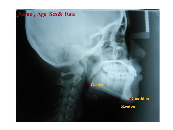 Name , Age, Sex& Date . Gonion Gnathion Menton 