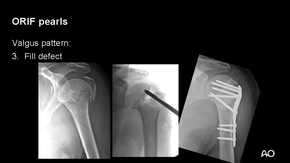 Proximal Humerus Overview Management Summary Content Prepared By