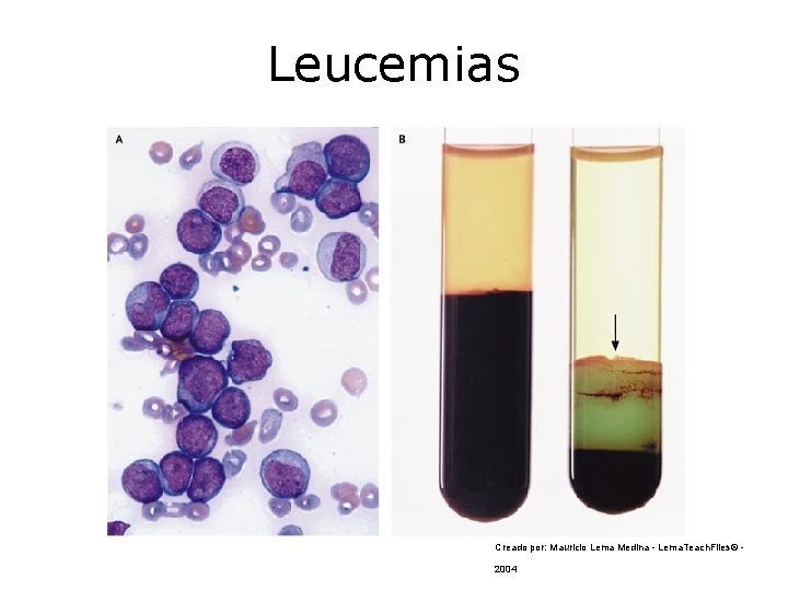 Leucemias Creado por: Mauricio Lema Medina - Lema. Teach. Files© 2004 