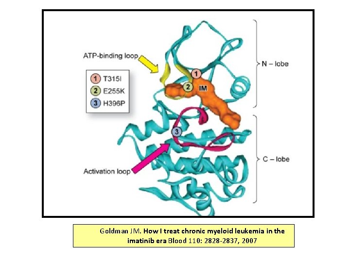 Goldman JM. How I treat chronic myeloid leukemia in the imatinib era Blood 110: