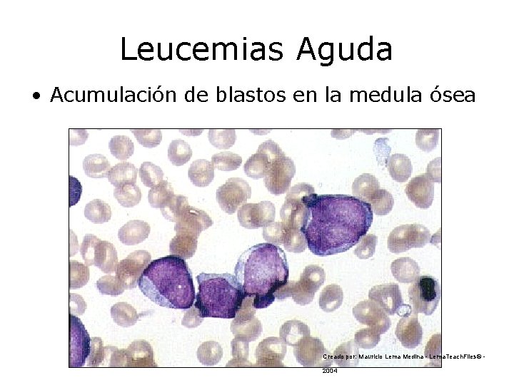 Leucemias Aguda • Acumulación de blastos en la medula ósea Creado por: Mauricio Lema