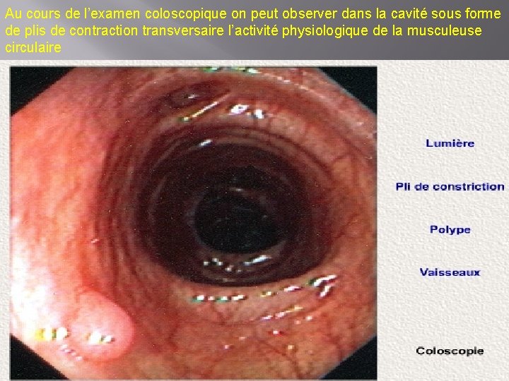 Au cours de l’examen coloscopique on peut observer dans la cavité sous forme de