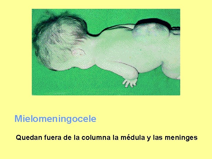 Mielomeningocele Quedan fuera de la columna la médula y las meninges 