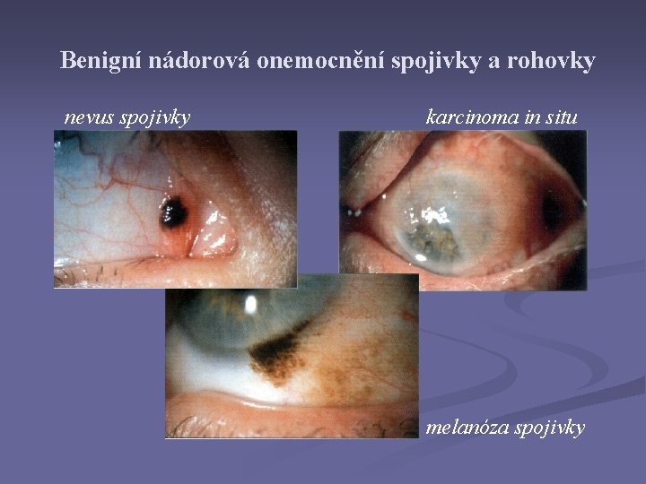 Benigní nádorová onemocnění spojivky a rohovky nevus spojivky karcinoma in situ melanóza spojivky 