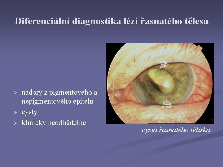 Diferenciální diagnostika lézí řasnatého tělesa Ø Ø Ø nádory z pigmentového a nepigmentového epitelu