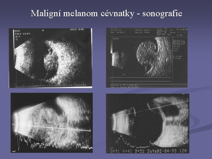 Maligní melanom cévnatky - sonografie Maligní melanom cévnatky - sonografie
