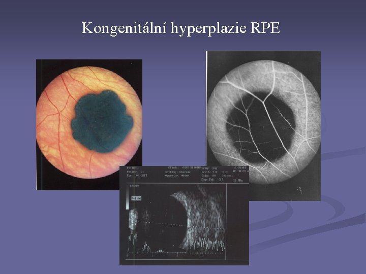 Kongenitální hyperplazie RPE Kongenitální hyperplazie RPE