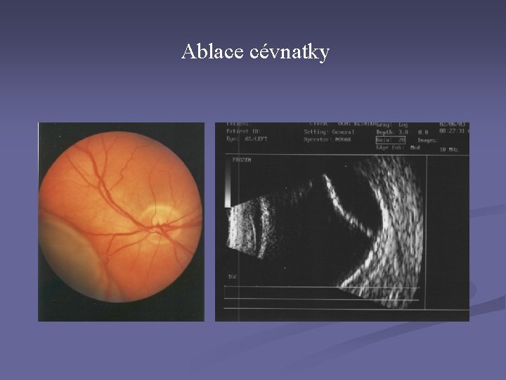 Ablace cévnatky Ablace cévnatky