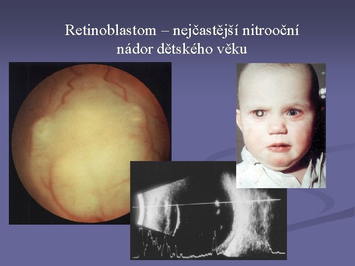 Retinoblastom – nejčastější nitrooční nádor dětského věku Retinoblastom – nejčastější nitrooční nádor dětského věku
