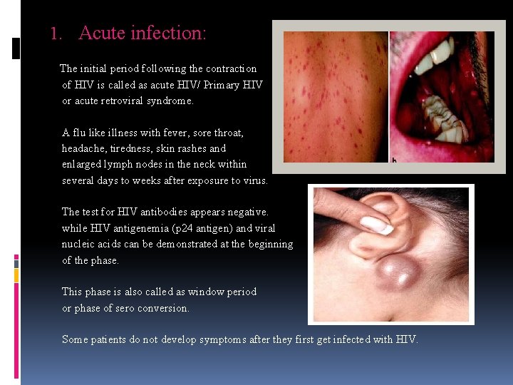 1. Acute infection: The initial period following the contraction of HIV is called as