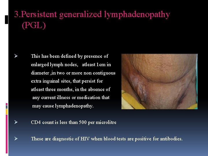 3. Persistent generalized lymphadenopathy (PGL) Ø This has been defined by presence of enlarged