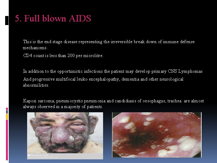 5. Full blown AIDS This is the end stage disease representing the irreversible break