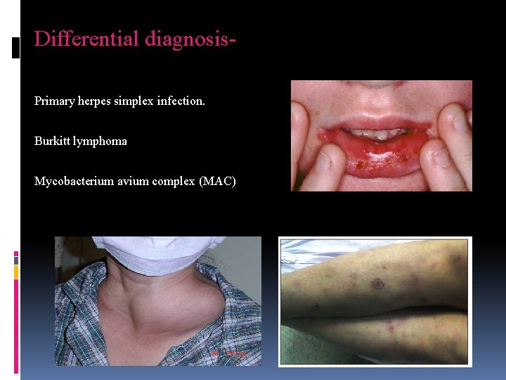 Differential diagnosis. Primary herpes simplex infection. Burkitt lymphoma Mycobacterium avium complex (MAC) 