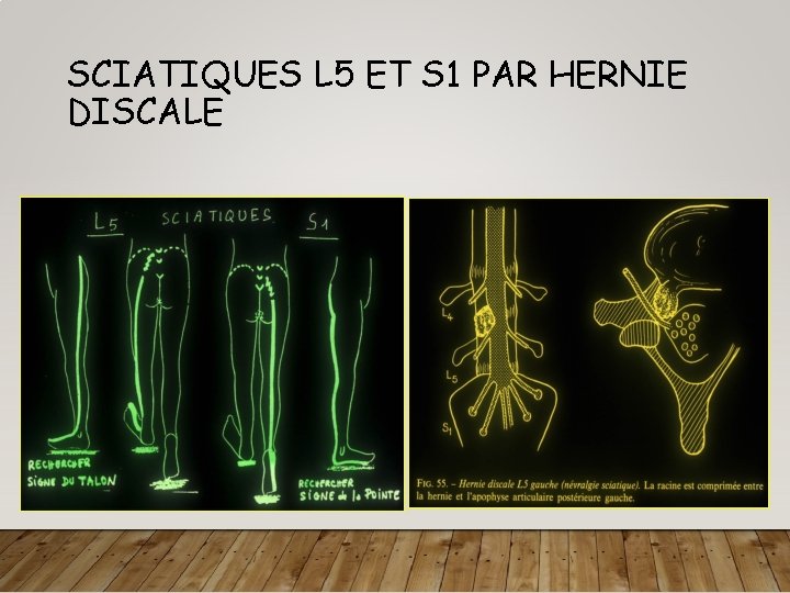 SCIATIQUES L 5 ET S 1 PAR HERNIE DISCALE 