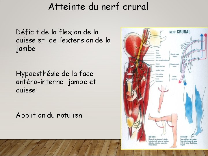 Atteinte du nerf crural Déficit de la flexion de la cuisse et de l’extension