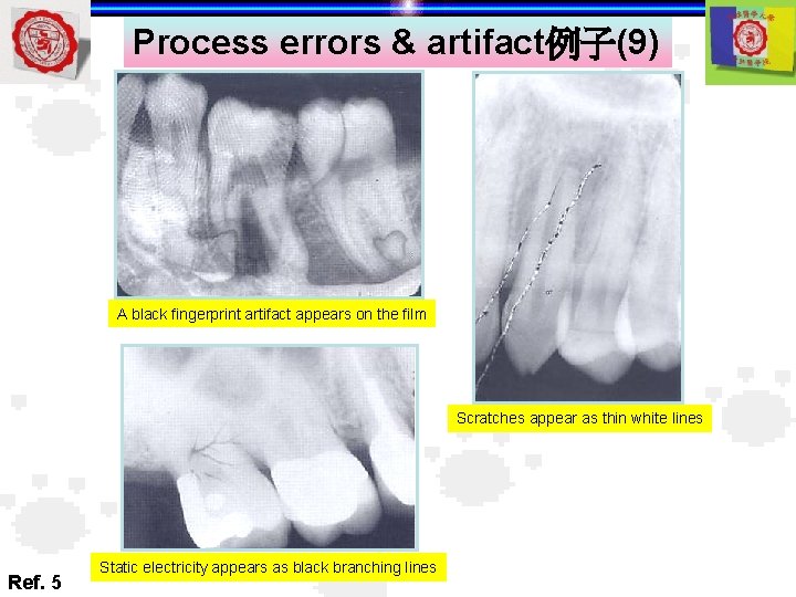 Process errors & artifact例子(9) A black fingerprint artifact appears on the film Scratches appear