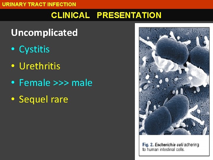 URINARY TRACT INFECTION CLINICAL PRESENTATION Uncomplicated • Cystitis • Urethritis • Female >>> male