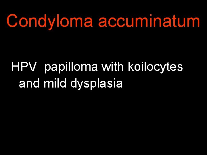 Condyloma accuminatum HPV papilloma with koilocytes and mild dysplasia 