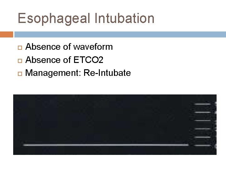 Esophageal Intubation Absence of waveform Absence of ETCO 2 Management: Re-Intubate 