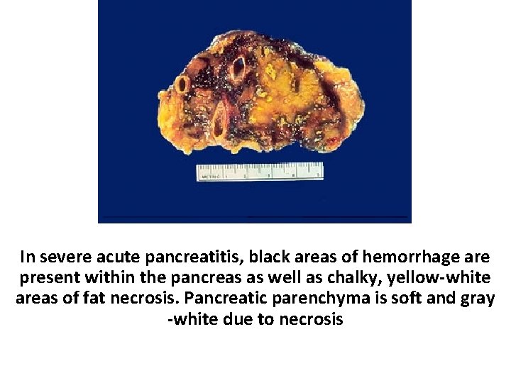 Pancreas In severe acute pancreatitis, black areas of hemorrhage are present within the pancreas